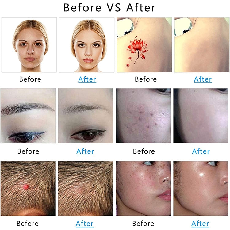 AA-A401 Small Freckle and Mole Removal Pen Tattoo and Eyebrow Removal Beauty Instrument, Color: Blu-ray Plug-in - HoMEdemic™ 